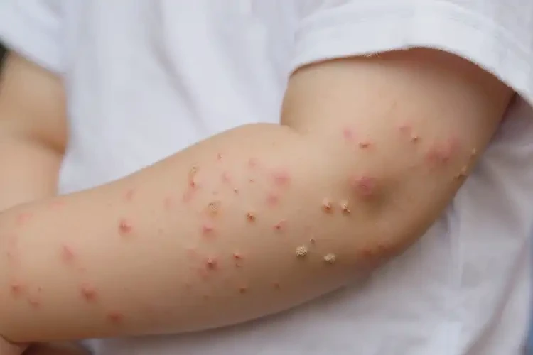 小學(xué)生全身經(jīng)常起濕疹不管它會自己痊愈嗎(圖4)