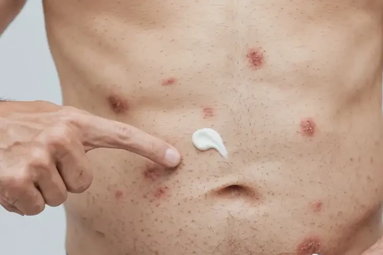 男人肚子经常长湿疹可以彻底自愈吗(图3)