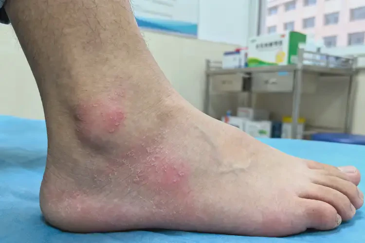 青年人脚上长湿疹可以彻底自愈吗(图1)