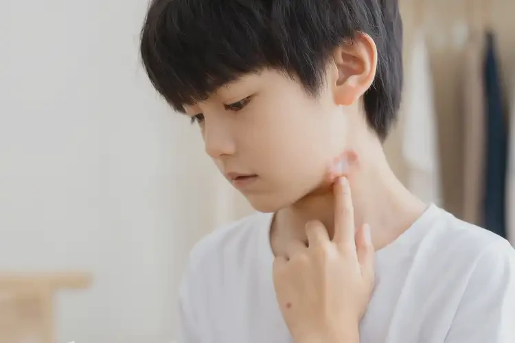 青少年脖子容易起濕疹能夠徹底治愈嗎(圖3)