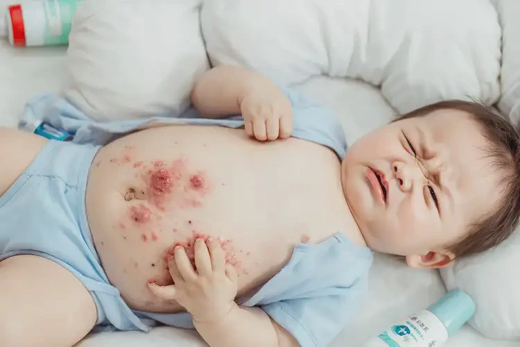 嬰幼兒肚子上經(jīng)常長(zhǎng)濕疹不管它會(huì)自己自愈嗎(圖4)