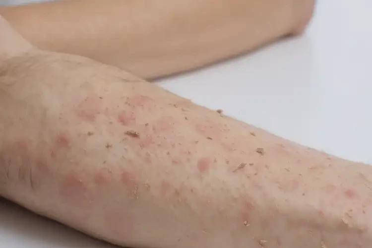 男生手臂上容易長濕疹能靠自己自愈嗎(圖4)