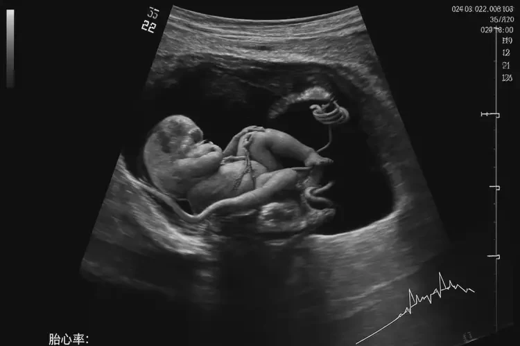 孕32周3天胎心率100還能保住嗎(圖4)