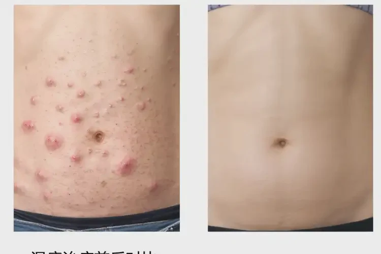 哺乳期媽媽肚子偶爾起濕疹可以徹底自愈嗎(圖3)