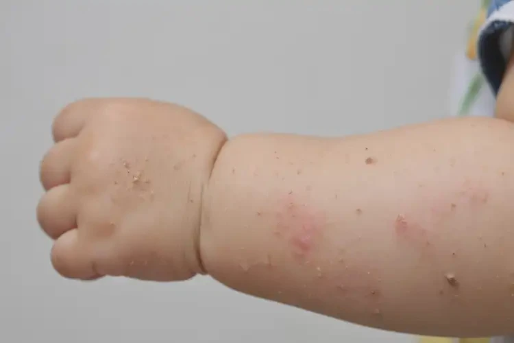 幼兒手上出濕疹不管它會(huì)自己痊愈嗎(圖4)