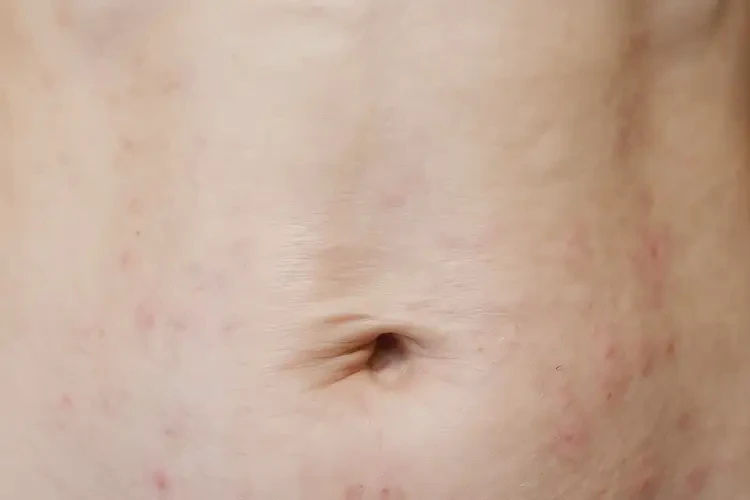 女性肛周偶尔长湿疹能够彻底治愈吗(图4)