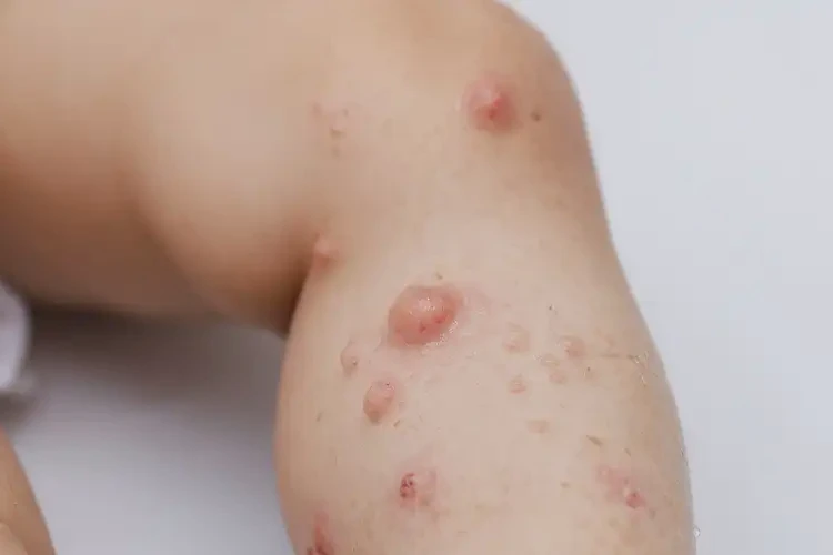 小兒大腿上出現(xiàn)濕疹不管它會自己好嗎(圖3)