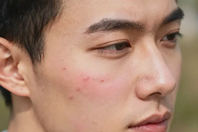 男人臉上偶爾長濕疹不管它會自己自愈嗎(圖3)