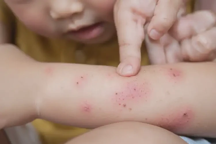 小兒手臂上容易長(zhǎng)濕疹可以徹底自愈嗎(圖4)