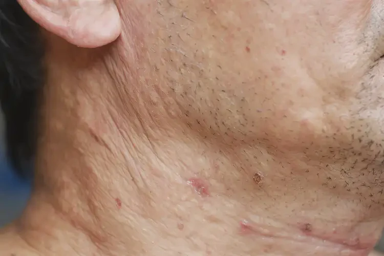 男性脖子上出現(xiàn)濕疹不管它會(huì)自己好嗎(圖4)