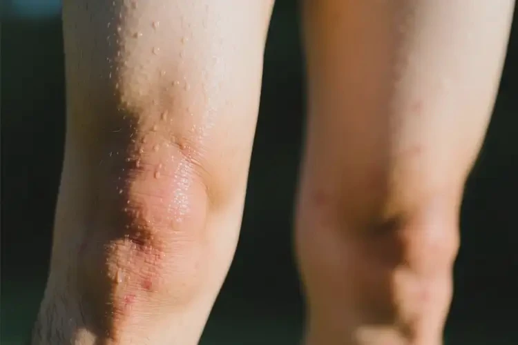 青年人大腿上長(zhǎng)濕疹能徹底自愈嗎(圖1)