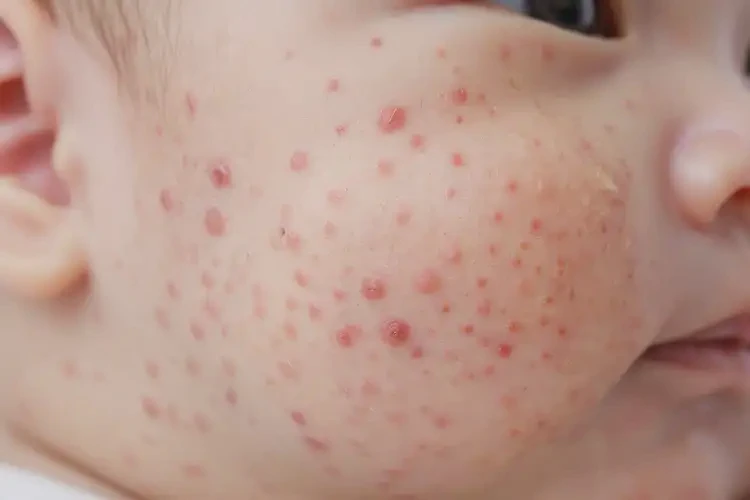 新生兒面部長濕疹可不可以徹底自愈(圖4)