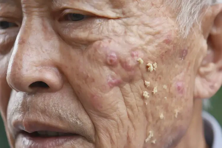 高齡老人面部容易長濕疹不管它會(huì)自己自愈嗎(圖4)