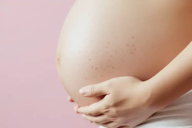 孕婦身上經(jīng)常起濕疹不管它會自己痊愈嗎(圖3)