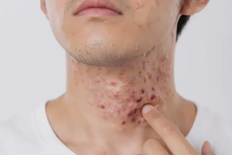 青年人脖子上起濕疹可以徹底自愈嗎(圖4)