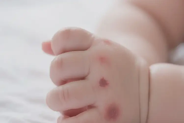 嬰兒手上偶爾起濕疹不管它會(huì)自己自愈嗎(圖4)