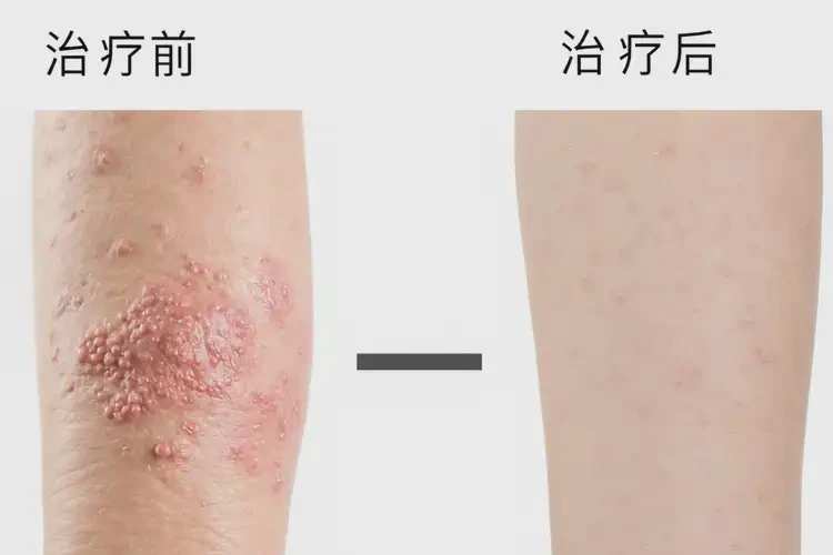 孩子手臂上出濕疹不管它會(huì)自己自愈嗎(圖1)