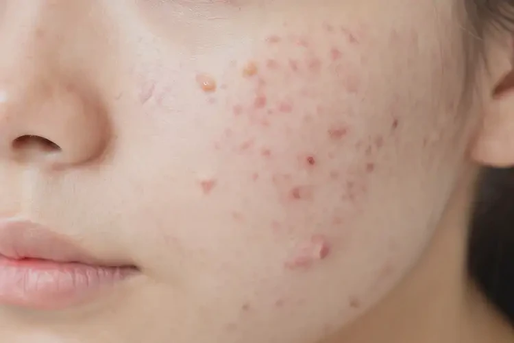 女性屁股上容易長濕疹可不可以徹底自愈(圖4)