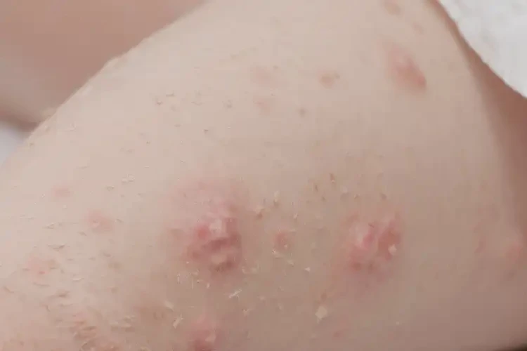 少兒小腿容易長(zhǎng)濕疹不管它會(huì)自己好嗎(圖4)