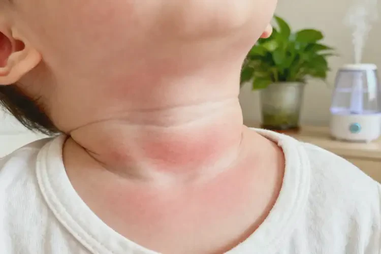 嬰幼兒脖子出濕疹可不可以徹底自愈(圖1)