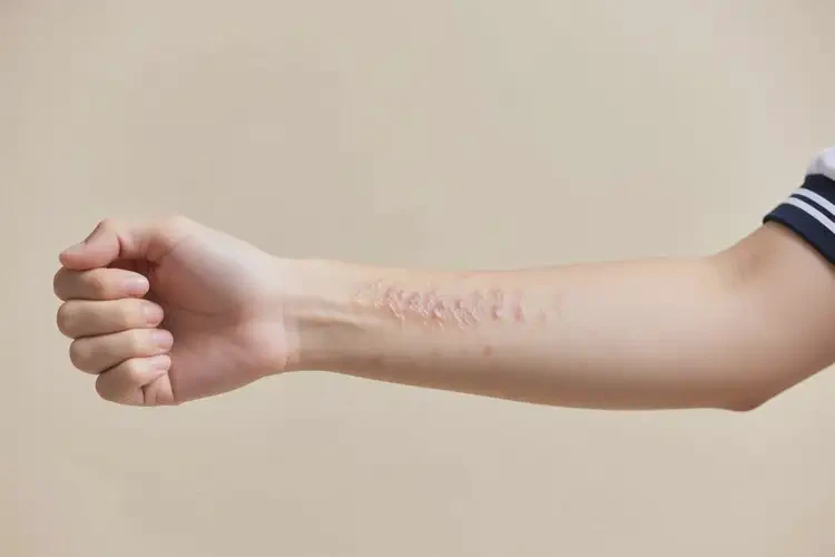 大學(xué)生手臂經(jīng)常起濕疹可以徹底自愈嗎(圖4)