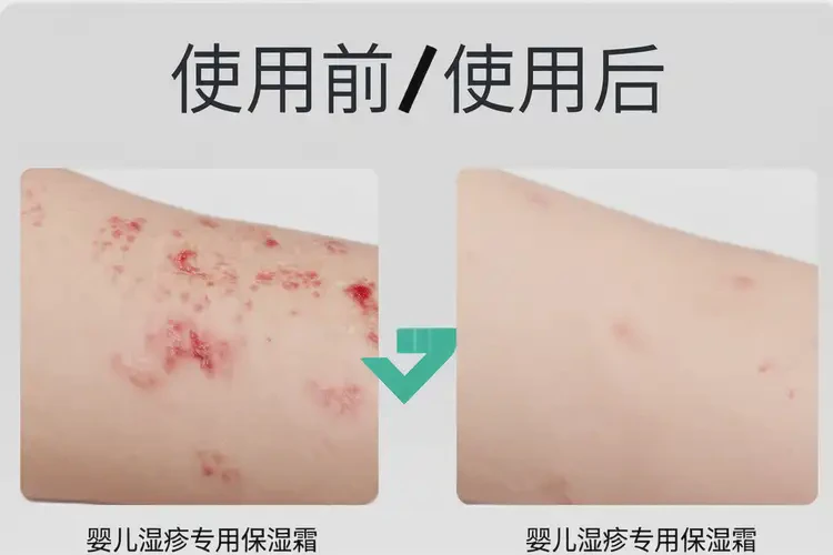 小孩身上经常长湿疹不管它会自己好吗(图2)