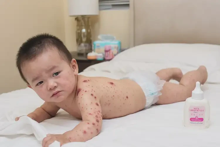 幼兒屁股上有濕疹不管它會自己好嗎(圖3)