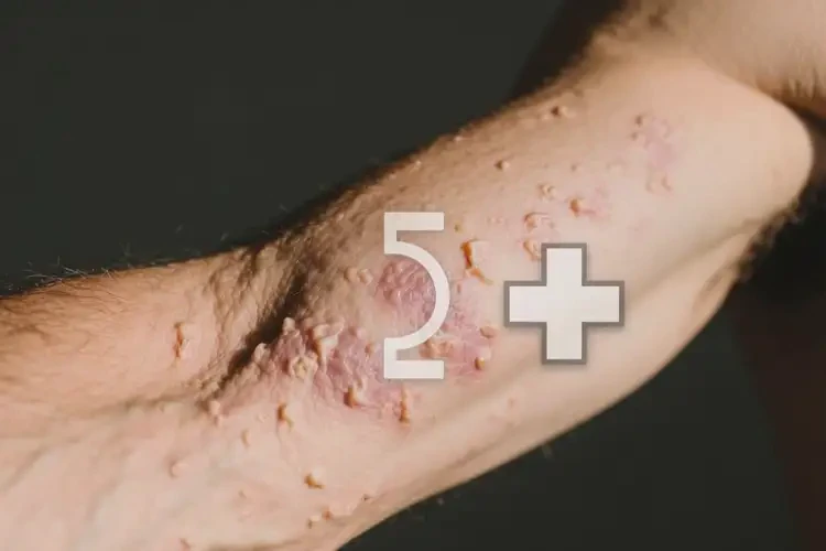 男人手臂上經(jīng)常長濕疹能夠徹底治愈嗎(圖2)