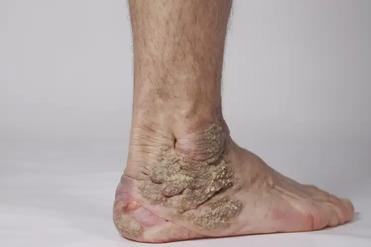 青少年腳上出濕疹可不可以徹底自愈(圖2)