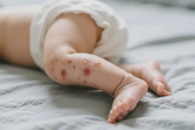 寶寶大腿有濕疹不管它會(huì)自己自愈嗎(圖1)