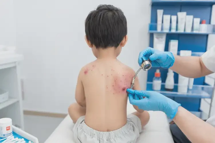 少兒屁股偶爾起濕疹能靠自己自愈嗎(圖4)