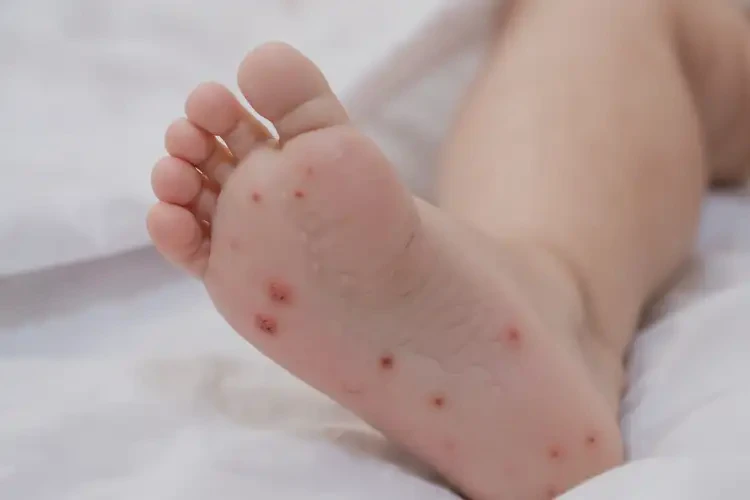 嬰幼兒腳上出現(xiàn)濕疹不管它會自己痊愈嗎(圖2)