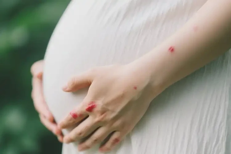 孕婦手上長濕疹能靠自己自愈嗎(圖2)