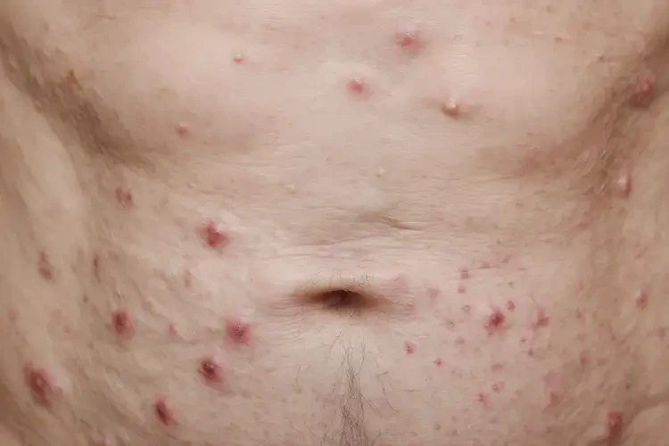 老人肚子上經常長濕疹能夠徹底治愈嗎(圖4)