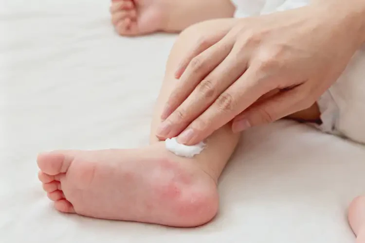 寶寶腳上出現(xiàn)濕疹能徹底自愈嗎(圖1)