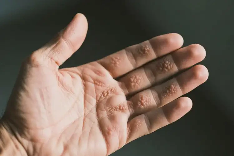 男人手上容易起濕疹不管它會(huì)自己好嗎(圖3)