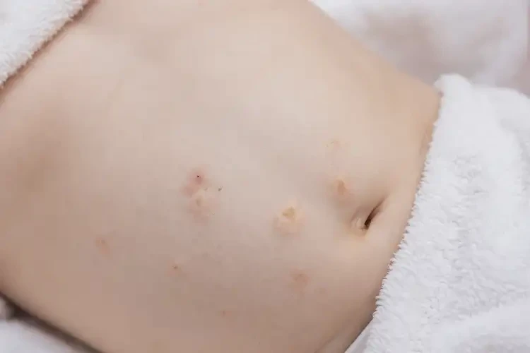 小孩肚子上起濕疹可不可以徹底自愈(圖4)