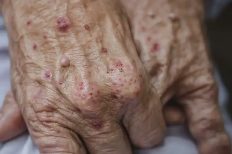 高齡老人手上偶爾起濕疹能不能徹底自愈(圖4)