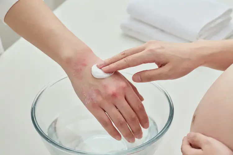 孕婦手上有濕疹不管它會(huì)自己好嗎(圖3)