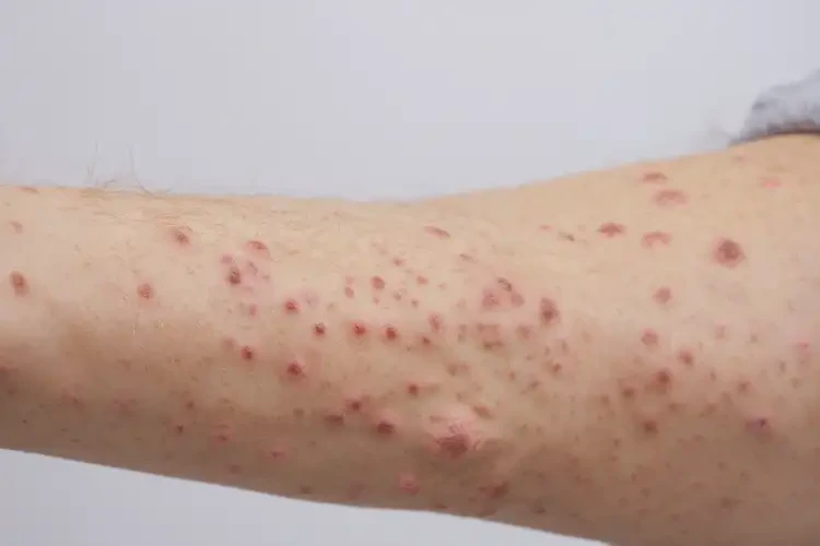 女人手臂上出濕疹能不能徹底自愈(圖4)