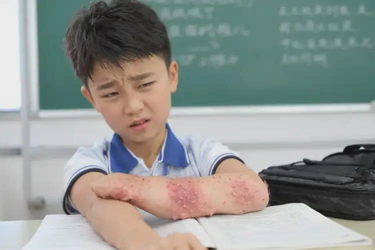 小學(xué)生手臂出現(xiàn)濕疹不管它會自己自愈嗎(圖4)