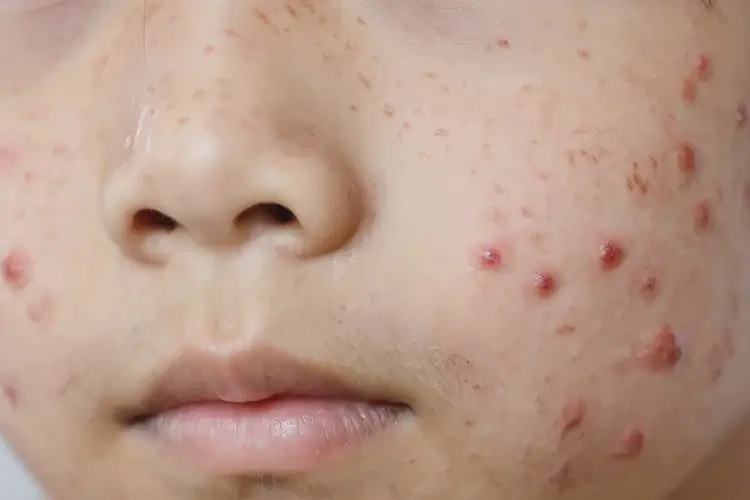 青少年臉上出濕疹可不可以徹底自愈(圖4)