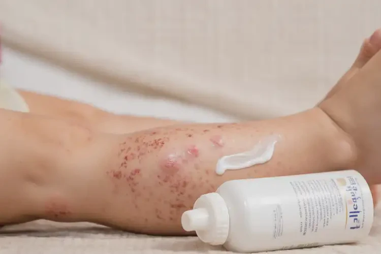 少兒小腿容易長(zhǎng)濕疹不管它會(huì)自己好嗎(圖2)