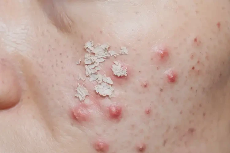 大學(xué)生肛周長濕疹不管它會自己痊愈嗎(圖4)