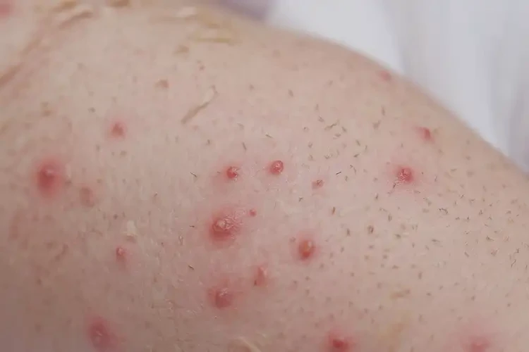 新生兒身上出濕疹不管它會自己痊愈嗎(圖4)