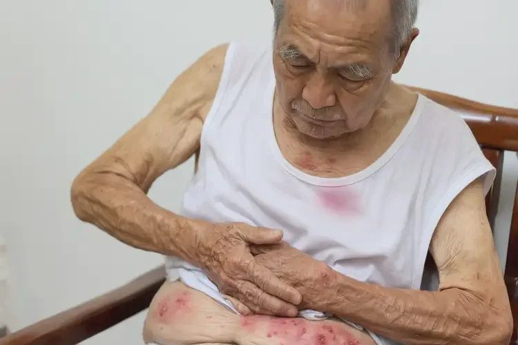 老人肚子上長濕疹不管它會自己好嗎(圖4)