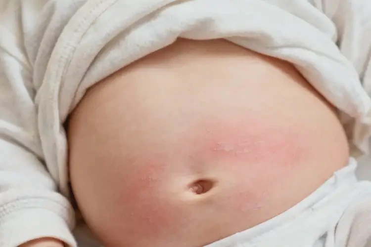 寶寶肚子出濕疹不管它會自己痊愈嗎(圖2)