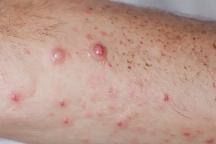 男生手臂經(jīng)常起濕疹可以徹底自愈嗎(圖4)