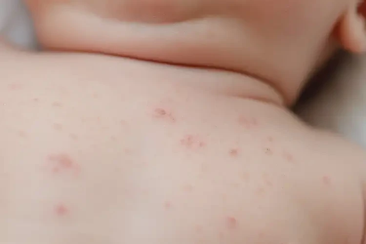 新生兒脖子經(jīng)常起濕疹能靠自己自愈嗎(圖4)