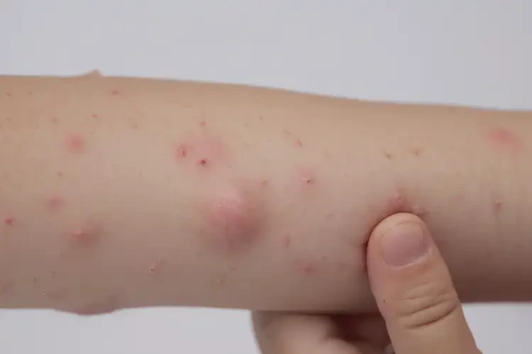 小孩肛周出湿疹不管它会自己好吗(图4)